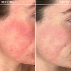 Redness Rescue Cream (RRC)